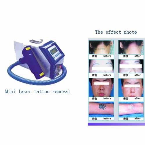 Best Tattoo removal machine with CE, very popular in Russion - M4C-II ...