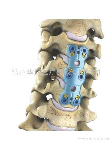 颈椎前后凸畸形矫正所致的颈椎不稳