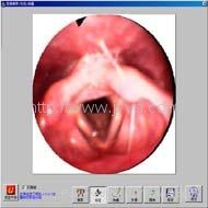 921980041_舌根淋巴滤泡病图片淋巴滤泡增生图片舌根淋巴滤泡