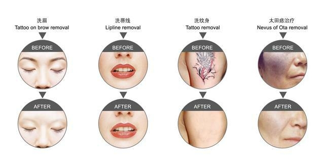 Hot sale q-switch nd yag laser tattoo removal m