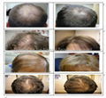 Laser Hair Growth System 3