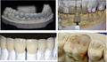 Denture 1