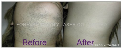 laser hair removal machine for home 3