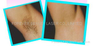 laser hair removal machine for home 4