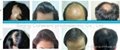 Diode laser hair growth therapy system 2