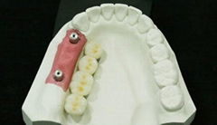 Sell Dental Implant Restoration