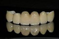 Sell Dental Cercon/Zirconium Crown and Bridge 1