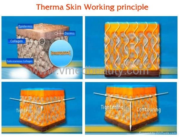 27MHZ CPT RF Skin Rejuvenation Thermage Equipment 3
