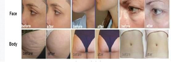 Multipolar RF Body Shaping System 2