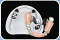 Telescopic Inner and Outer crowns 1