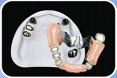 Telescopic Inner and Outer crowns