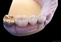 Dental Fixed Porcelain Gold Crown/Precious metal denture crown and bridge 1