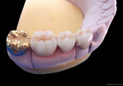 Dental Fixed Porcelain Gold Crown/Precious metal denture crown and bridge