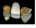 Dental Fixed Porcelain Gold Crown/Precious metal denture crown and bridge 2