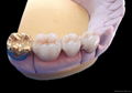 Dental Fixed Porcelain Gold Crown/Precious metal denture crown and bridge 3