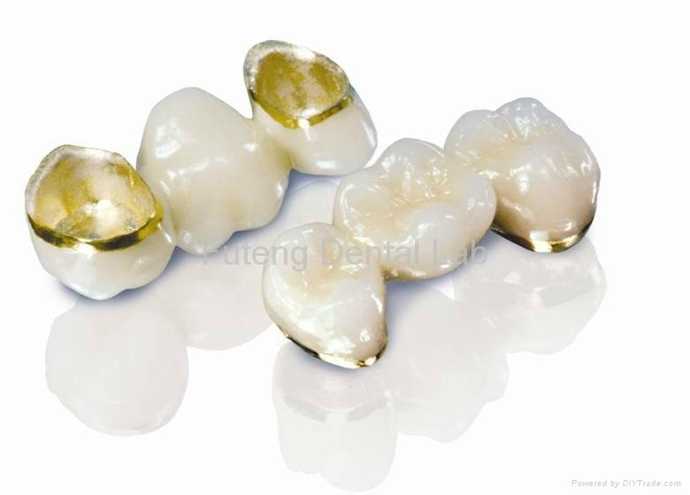 Dental Captak teeth restoration / Precious high noble porcelain metal crown