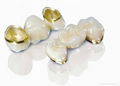 Dental Captak teeth restoration / Precious high noble porcelain metal crown 1