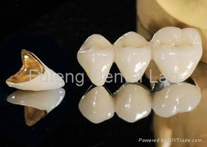 Dental Captak teeth restoration / Precious high noble porcelain metal crown 3