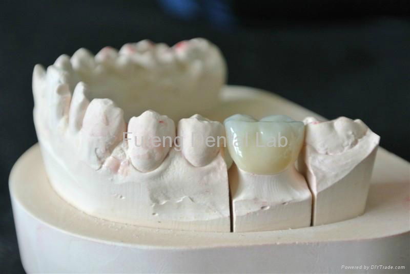 IPS E.max all ceramic Crown /Empress casting porcelain bridge 4