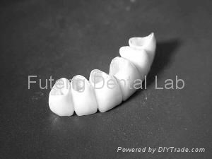 Dental CAD/CAM Wieland & Lava & Cercon Zirconia all ceramic  aesthetic crown  2