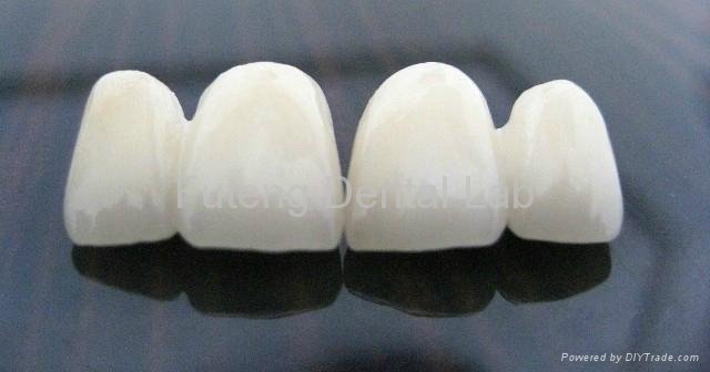 Dental CAD/CAM Wieland & Lava & Cercon Zirconia all ceramic  aesthetic crown  3