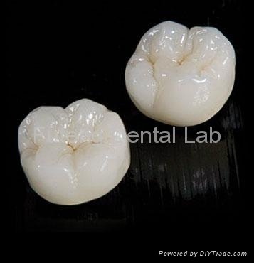 Dental CAD/CAM Wieland & Lava & Cercon Zirconia all ceramic  aesthetic crown  5