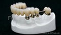 Telescope crown with partial removable acrylic denture	 1