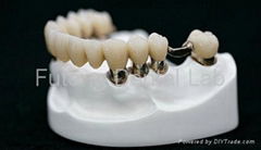 Telescope crown with partial removable acrylic denture	