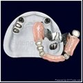 Telescope crown with partial removable acrylic denture	 2