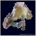 Telescope crown with partial removable acrylic denture	 3