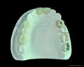 Implant Casting abutment/ Implant all Ceramic Crown 3