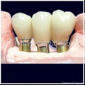 Implant Casting abutment/ Implant all Ceramic Crown 4