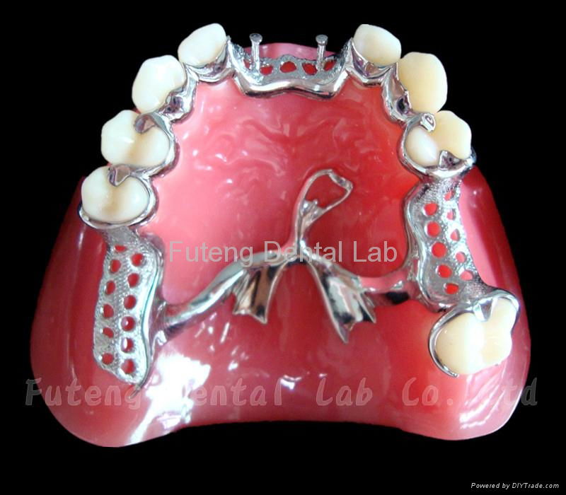 Removable Metal Framework with partial acrylic resin teeth set up/ finish