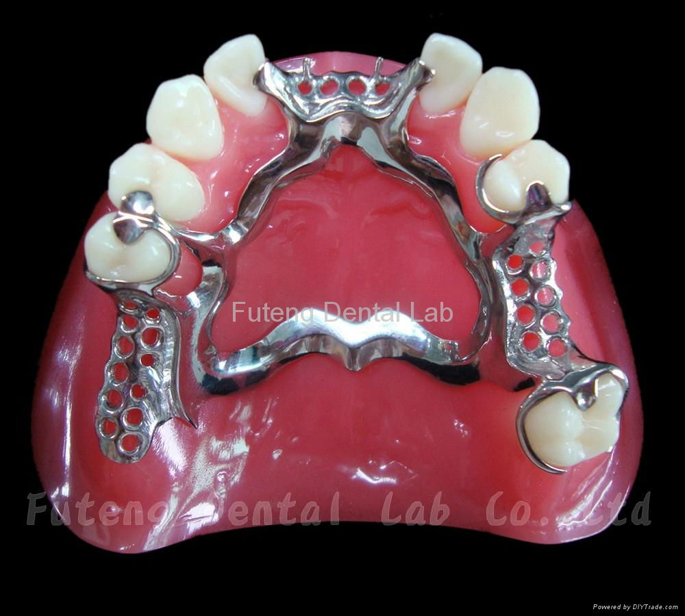Removable Metal Framework with partial acrylic resin teeth set up/ finish 2