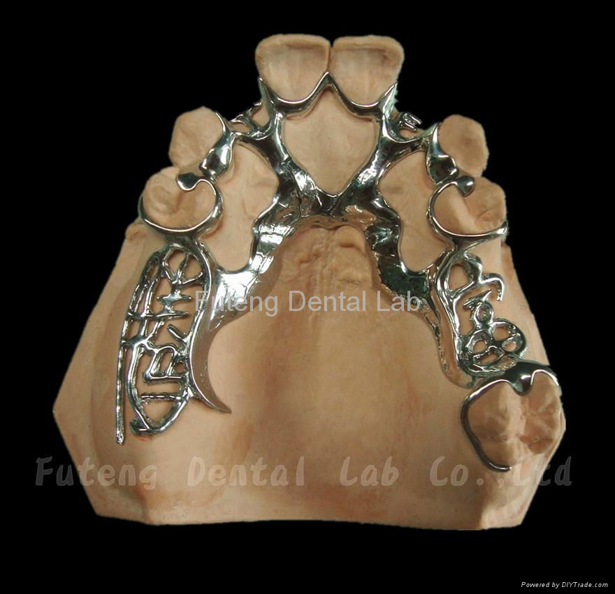 Removable Metal Framework with partial acrylic resin teeth set up/ finish 3