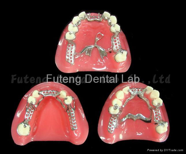 Removable Metal Framework with partial acrylic resin teeth set up/ finish 4