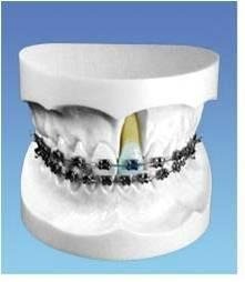 Orthodontic Model for Demonstration with Edgewise Bracket