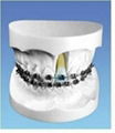 Orthodontic Model for Demonstration with Edgewise Bracket