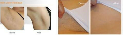 2013 new products hair removal laser machine price 4