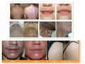 IPL hair removal skin rejuvenation 5