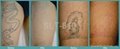 q switched nd yag tattoo removal laser 3