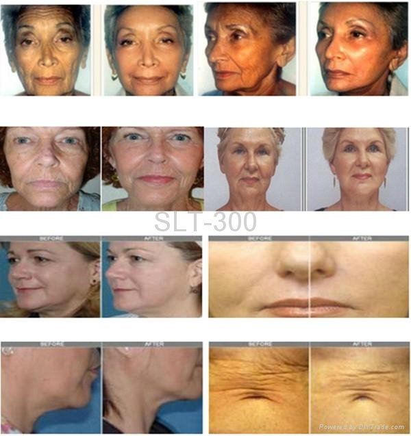 radio frequency face lift wrinkle removal 5