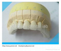 2013 hot dental Non-precious PFM denture/pfm dental crown denture  