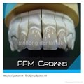 2013 hot dental Non-precious PFM denture/pfm dental crown denture   3