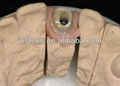 2013 hot dental implant /pfm implant crown /implant teeth  2