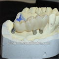 2013 hot dental implant /pfm implant crown /implant teeth  3