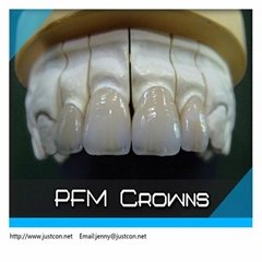 2013 hot Non-precious PFM/pfm dental crown denture  