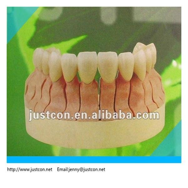 2013 hot Non-precious PFM/pfm dental crown denture   2