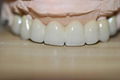 2013 hot Dental Implants crowns /dental parts/zirconia implant teeth   