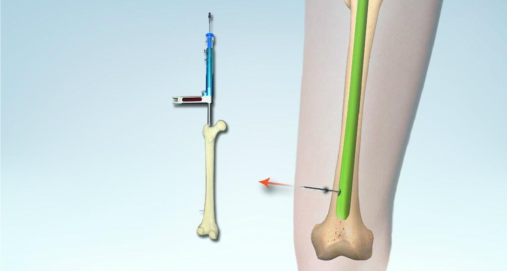 伽玛型髓内钉ii型加长型